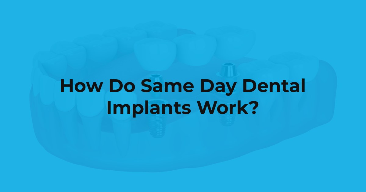 How Do Same Day Dental Implants Work? at Yen Oral Surgery
